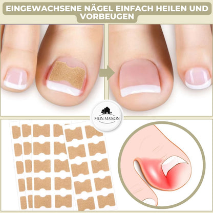 FixaNail | Innovatives Nagelkorrektursystem für gesunde Nägel 1