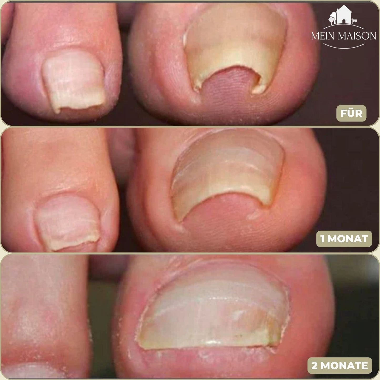 FixaNail | Innovatives Nagelkorrektursystem für gesunde Nägel 3