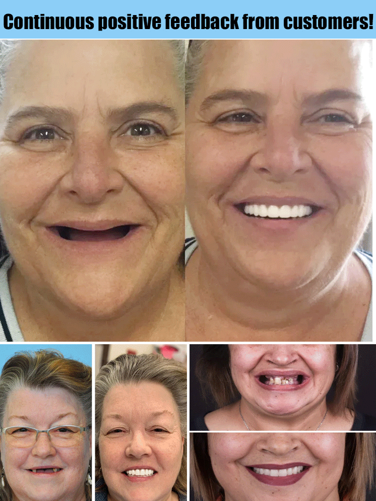 Smilvea | Set dental cosmético superior e inferior, moldeable en agua caliente